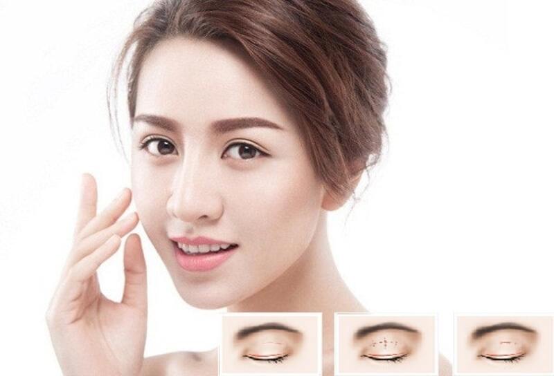 Ưu điểm của cắt mí mắt Hàn Quốc (Nguồn: Internet)