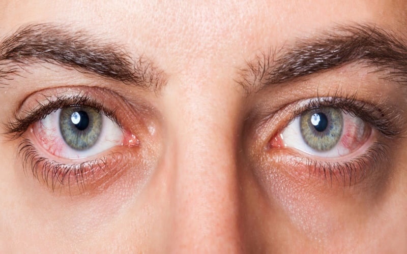 Cắt mí không nhắm được mắt phải làm sao?