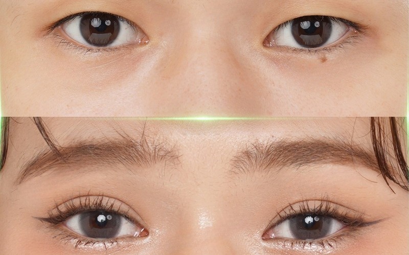 Cắt mí kiêng ăn gì? Ăn uống sao để mau lành, không sẹo!