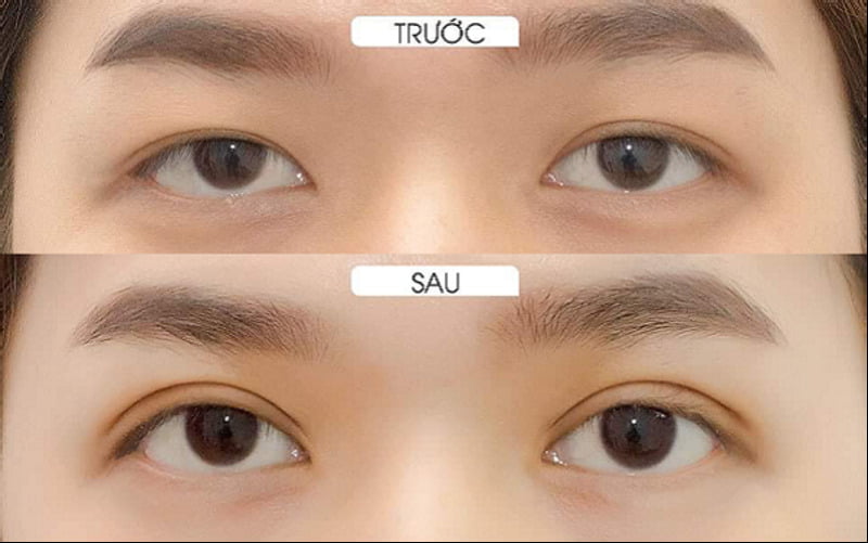 Cắt mí là gì? (Nguồn: Internet)