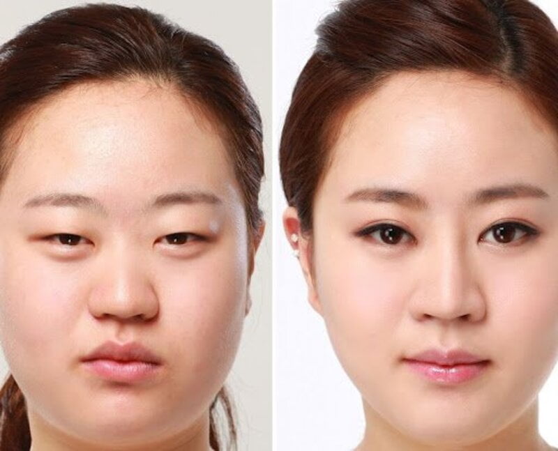 Cắt mí mắt giúp bạn tự tin hơn rất nhiều (Nguồn: Internet)