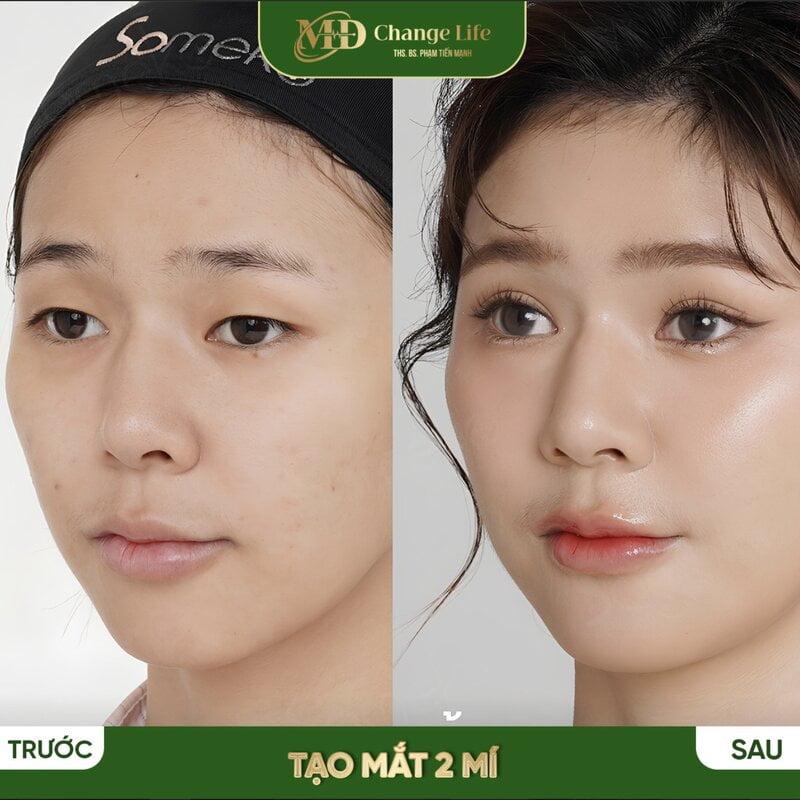 Trước và sau khi cắt mí mắt đẹp tại MD Change Life (Nguồn: MD Change Life)