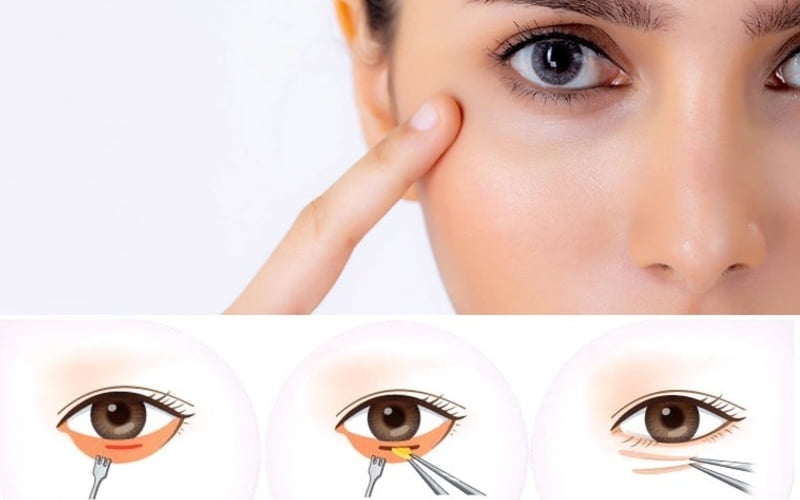 Cắt mí dưới (Nguồn: Internet)