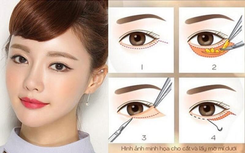 Quy trình cắt mí mắt dưới (Nguồn: Internet)