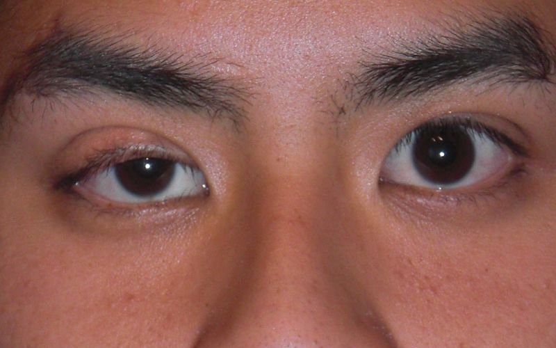 Mí lệch sau cắt (Nguồn: Internet)