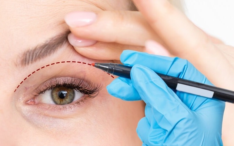 Chỉnh sửa cắt mí mắt hỏng (Nguồn: Internet)