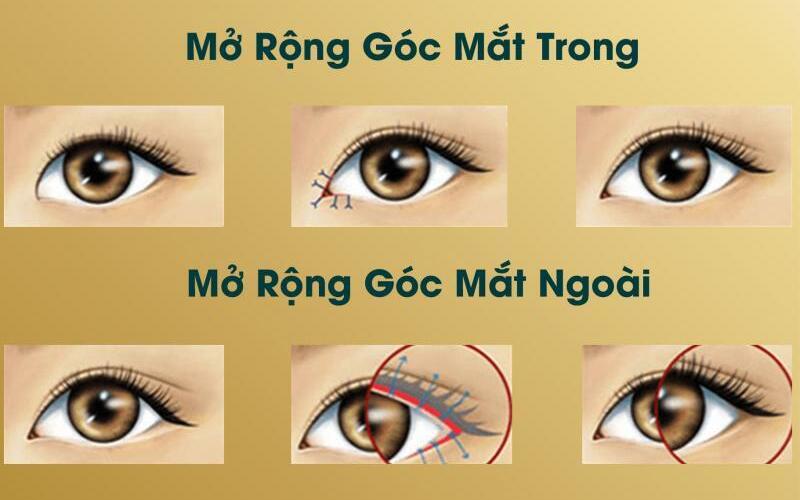 Top 5 Địa Chỉ Cắt Mí Mở Góc Mắt Hà Nội Uy Tín