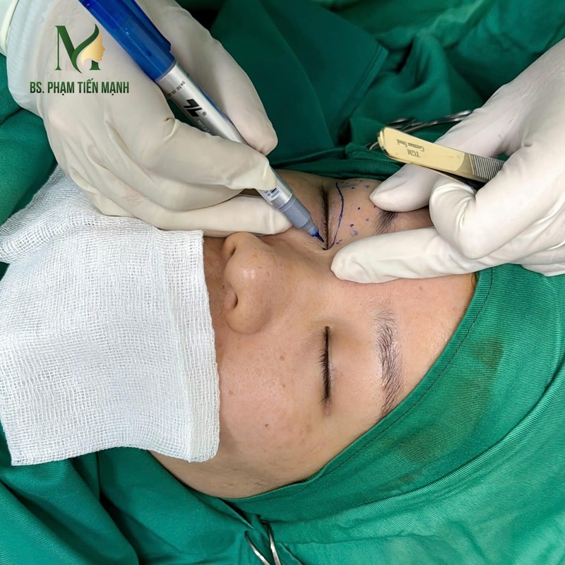 Top 5 Địa Chỉ Cắt Mí Mở Góc Mắt Hà Nội Uy Tín