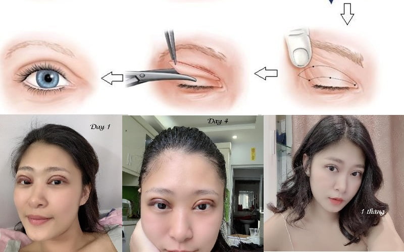 Cắt mí nên ăn gì cho mau lành? Top 4 thực phẩm tốt cho người cắt mí