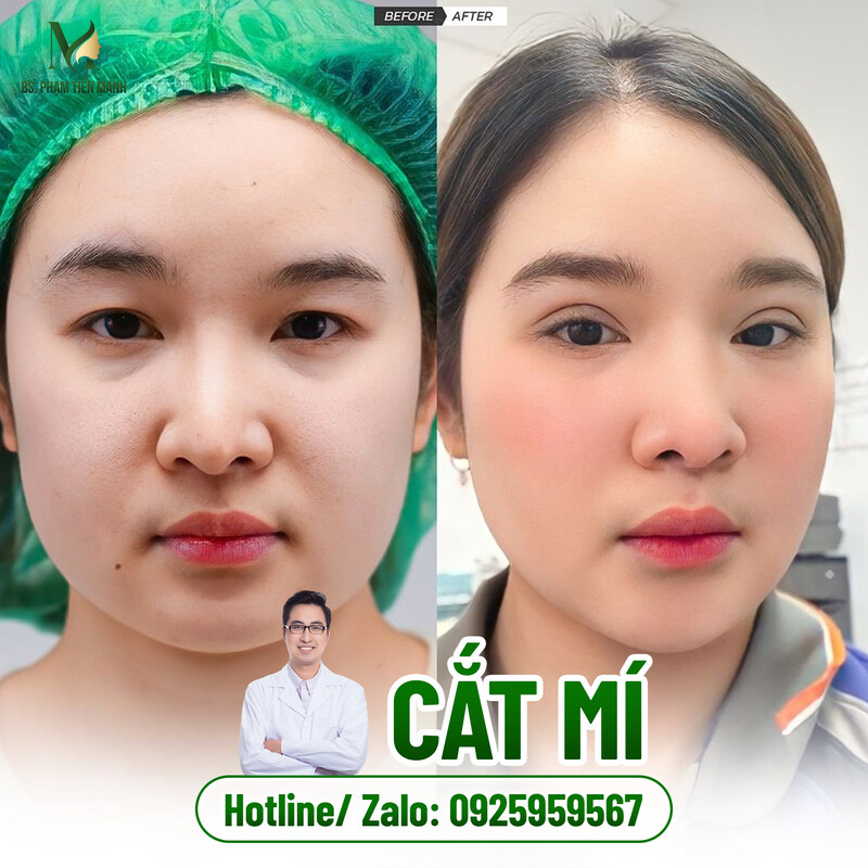 Dịch vụ cắt mí uy tín tại Thẩm Mỹ MD Change Life Nghệ An (Nguồn: Thẩm Mỹ MD Change Life)