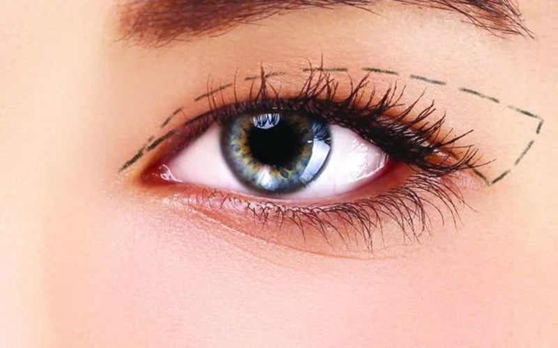 Cắt mí ở đâu đẹp hiện là câu hỏi rất được nhiều người quan tâm (Nguồn: Internet)