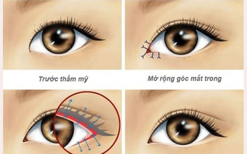 Tạo hình cắt mí phượng hoàng (Nguồn: Internet)