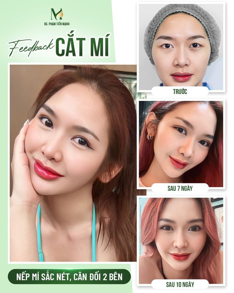 Hình ảnh khách hàng trước và sau khi cắt mí phượng hoàng tại Thẩm Mỹ MD Change Life (Nguồn: MD Change Life)