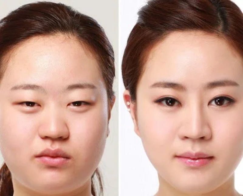 Cắt mí sau 6 tháng: Đã hoàn toàn hồi phục và đẹp tự nhiên? (Nguồn: Internet)