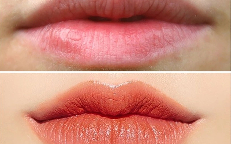 Cắt môi (Nguồn: Internet)