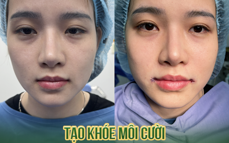 Cắt môi bao lâu hết sưng? Giải đáp từ bác sĩ 10 năm kinh nghiệm