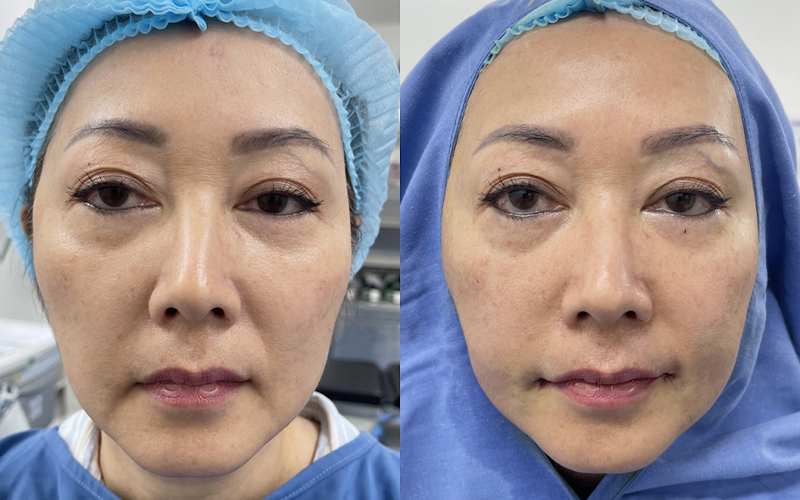 Cắt môi tự nhiên tại Thẩm mỹ MD Change Life (Nguồn: MD Change Life)