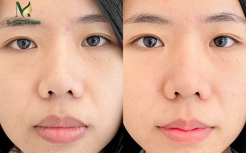 Cắt môi tự nhiên tại Thẩm mỹ MD Change Life (Nguồn: MD Change Life)