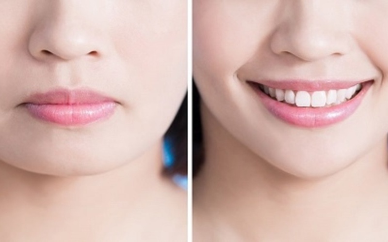 Tạo hình lại khóe môi tạo hiệu ứng môi cười tự nhiên ( Nguồn : Internet )