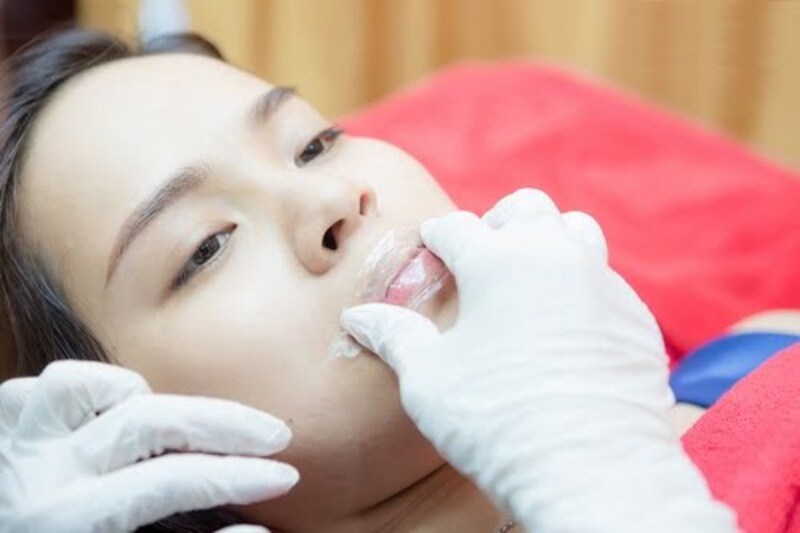 Gây tê trước khi thực hiện tạo khóe cười ( Nguồn : Internet )