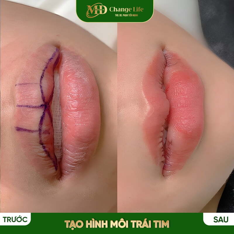 Hình ảnh khách tạo hình khóe môi thành công ( Nguồn : MD Change Life )