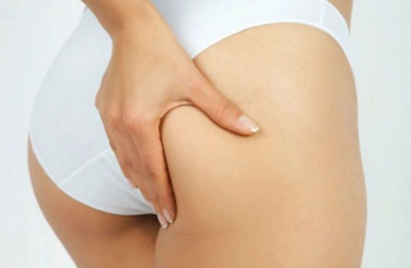 Cấy mỡ hõm mông giúp chị em có một vòng 3 căng tròn (Nguồn: Internet)