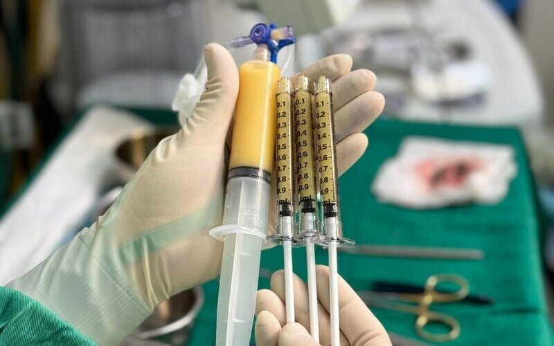 Cấy mỡ mặt (Nguồn: Internet)