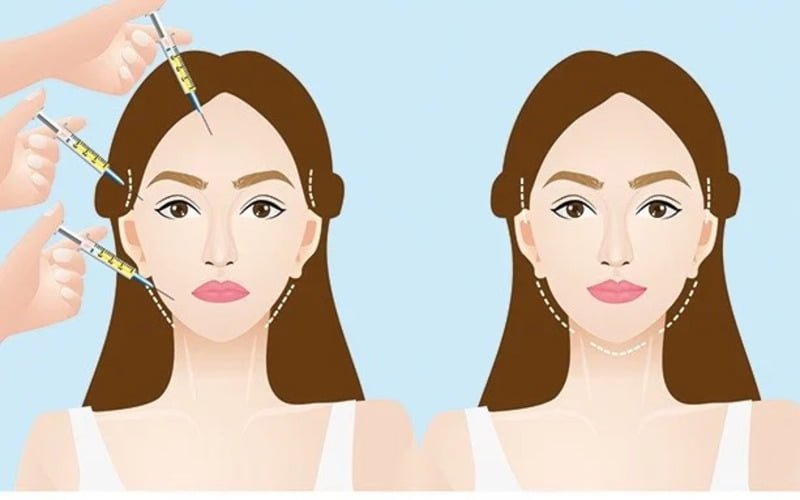 Quy trình cấy mỡ mặt chuẩn y khoa (Nguồn: Internet)