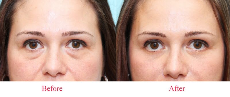 Trải nghiệm tiêm cấy mỡ mắt tại MD Change Life (Nguồn: Internet)