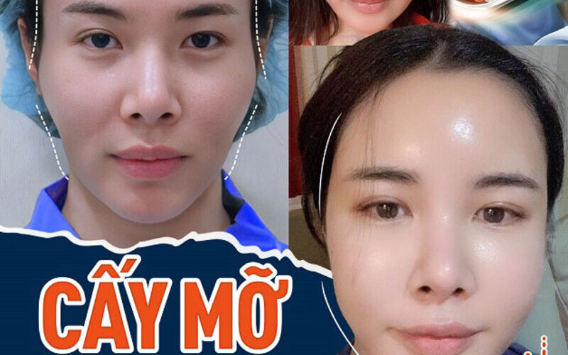 Top 6 địa chỉ cấy mỡ mặt tốt nhất Nghệ An