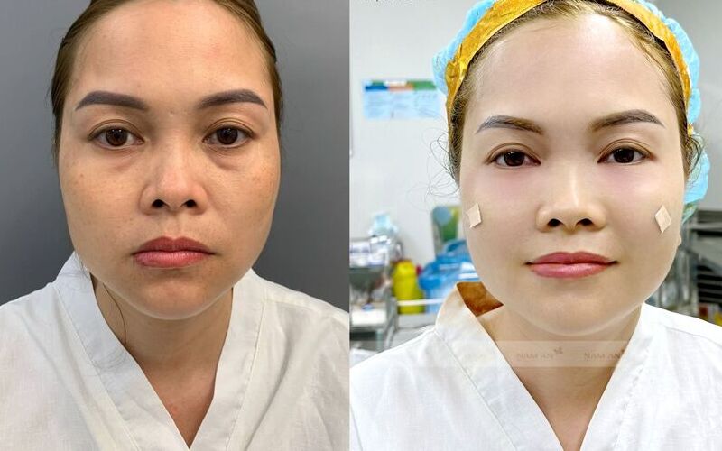 Top 6 địa chỉ cấy mỡ mặt tốt nhất Nghệ An