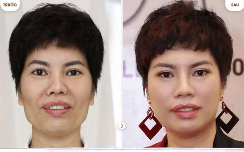 Top 6 địa chỉ cấy mỡ mặt Hà Nội tốt nhất