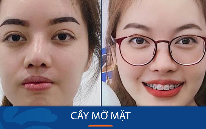 Top 6 địa chỉ cấy mỡ mặt Hà Nội tốt nhất