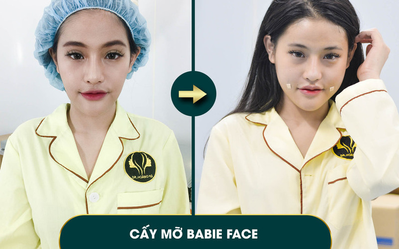 Top 6 địa chỉ cấy mỡ mặt Hà Nội tốt nhất