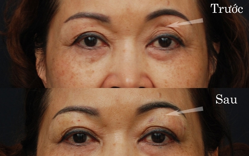 Top 5 địa chỉ cấy mỡ mắt uy tín nhất tại Nghệ An