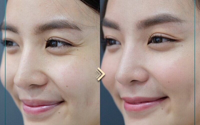 Top 5 địa chỉ cấy mỡ mắt uy tín nhất tại Nghệ An