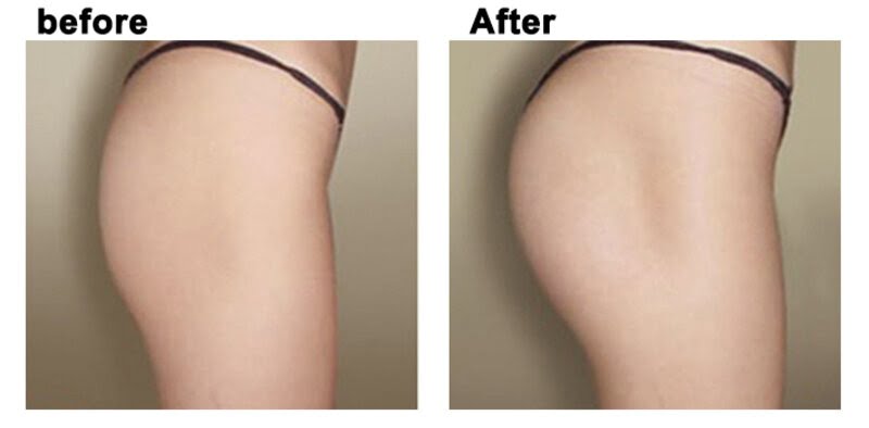 Cấy mỡ mông bằng mỡ tự thân là như thế nào (Nguồn: Internet)