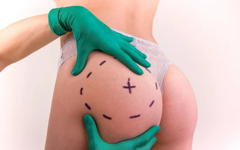 5 địa chỉ cấy mỡ mông bằng mỡ tự thân Hà Nội