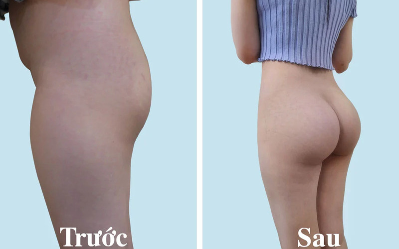 5 địa chỉ cấy mỡ mông bằng mỡ tự thân Hà Nội