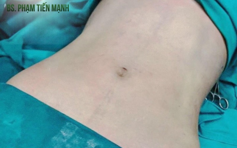 Chăm sóc sau hút mỡ bụng: Hướng dẫn chi tiết để nhanh chóng hồi phục