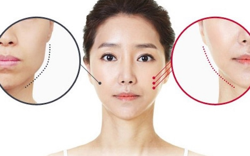 Phẫu thuật gọt hàm là gì? (Nguồn: Internet)