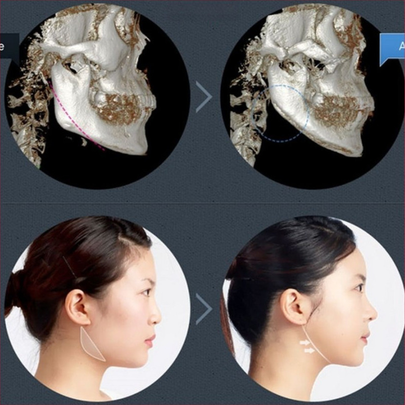 Tại sao nhiều người lựa chọn gọt hàm? (Nguồn: Internet)