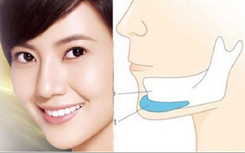 Các yếu tố ảnh hưởng đến chi phí phẫu thuật gọt hàm (Nguồn: Internet)