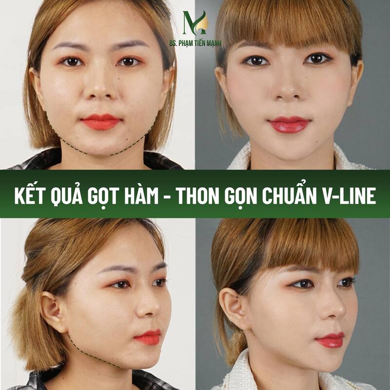 Thẩm Mỹ MD Change Life - Địa chỉ gọt hàm uy tín tại Hà Nội (Nguồn: MD Change Life)