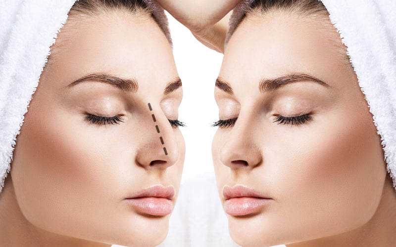 Mũi gãy do tai nạn gây mất thẩm mỹ (Nguồn: Internet)