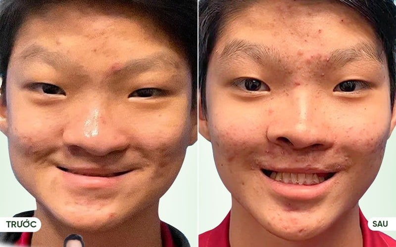 Chỉnh hình mũi tại MD Change Life (Nguồn: Thẩm mỹ MD Change Life)