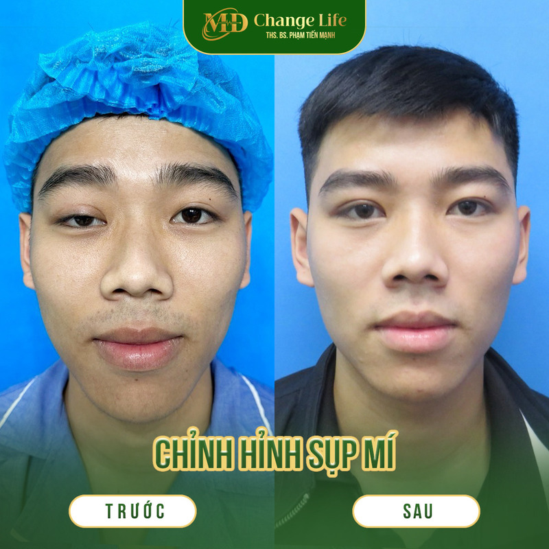 Kết quả chỉnh hình sụp mí tại Thẩm Mỹ MD Change Life (Nguồn: Thẩm Mỹ MD Change Life)