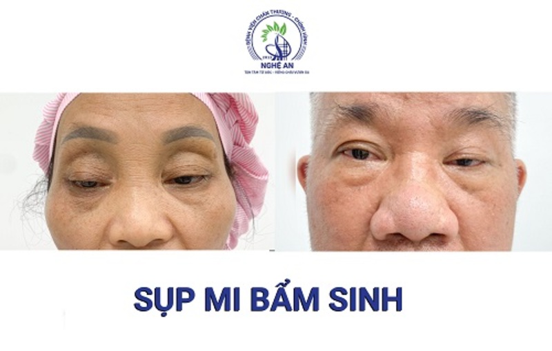 Chỉnh hình sụp mí tại Bệnh viện Chấn Thương Chỉnh Hình Nghệ An, Khoa Phẫu Thuật - Tạo Hình - Thẩm Mỹ (Nguồn: Bệnh viện Chấn Thương Chỉnh Hình Nghệ An)