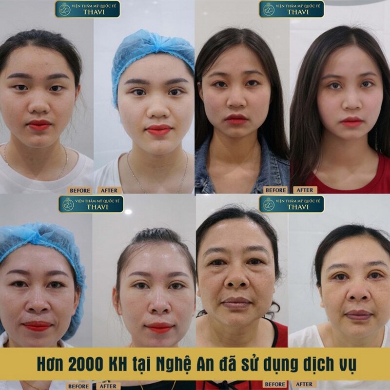 Chỉnh hình sụp mí Nghệ An tại Thẩm Mỹ viện ThaVi (Nguồn: Thẩm Mỹ viện ThaVi)