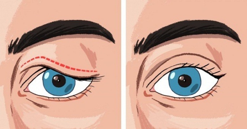 Dịch vụ chỉnh hình sụp mí tại Bệnh Viện Mắt Nghệ An (Nguồn: Internet)